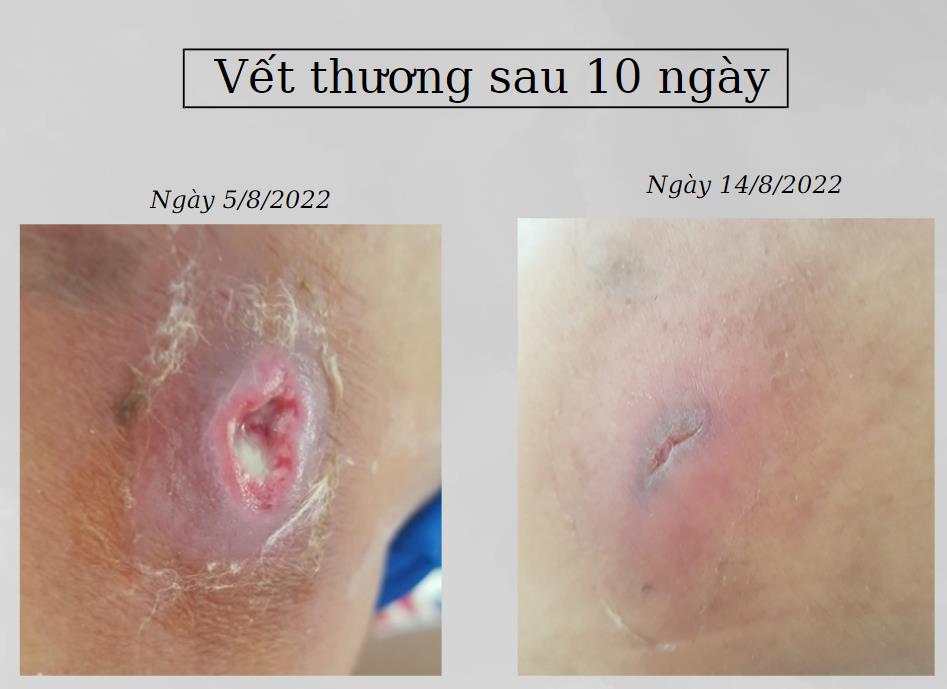 Vết thương nhiễm trùn sau 10 ngày điều trị với DSD PD Curcumin